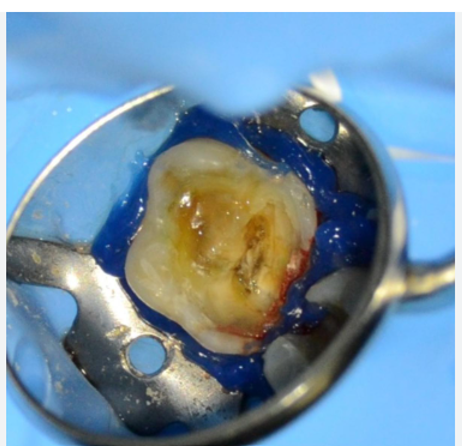 Impedance-Guided Canal Localisation Is Changing The Rules Of Endodontics