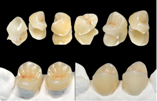 Should Dentists Choose Lithium Disilicate Endocrowns Over Direct Composites? New Research Highlights a Significant Strength Advantage