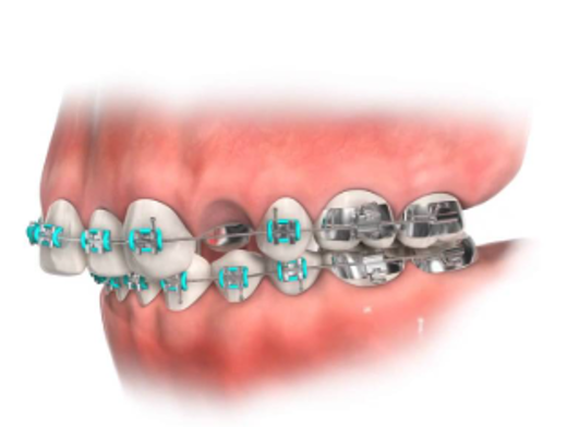 How Much Tooth Movement Is Too Much? New Research Warns Orthodontists About Root Resorption Risk
