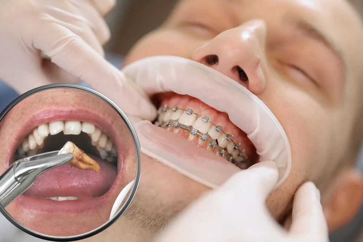 Does the Timing of Tooth Extraction Affect Orthodontic Treatment?
