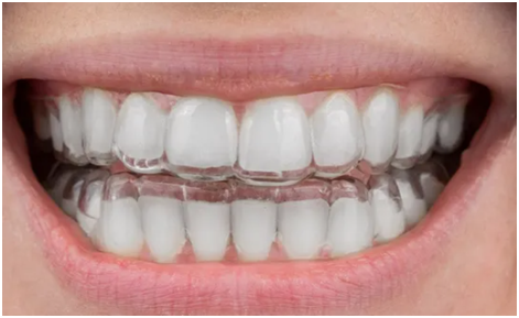 Cola and Clear Aligners: What Dentists Should Know About pH and the Oral Microbiome