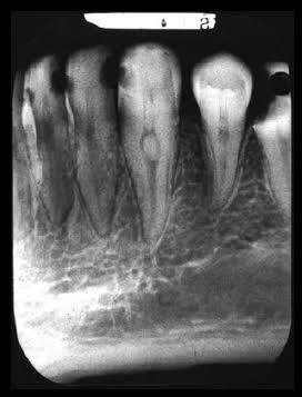 Pulp Stones and Diabetes: What Every Endodontist Should Know from the Latest CBCT Research
