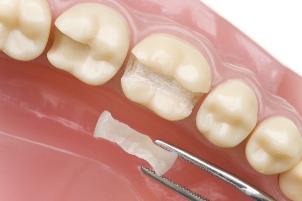 This Patented Technology Could End Repeat Cavities