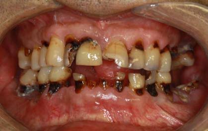 38% Silver Diamine Fluoride May Help Protect Teeth After Head & Neck Radiotherapy: A New Hope Against Radiation-Induced Caries