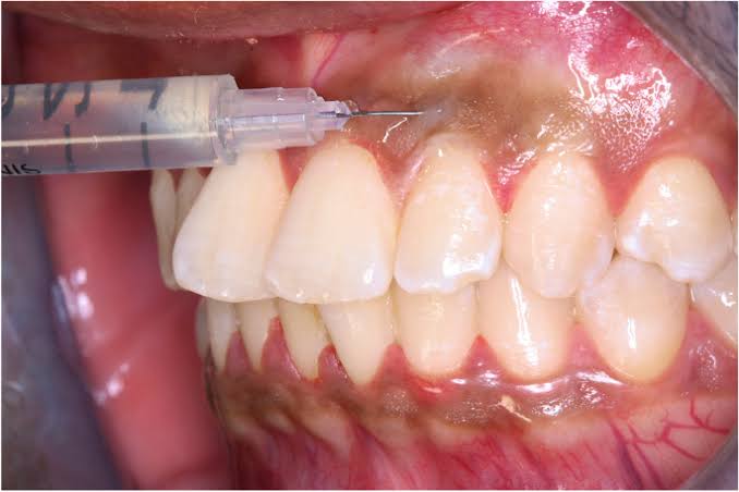 Vitamin C Injections for Gingival Depigmentation